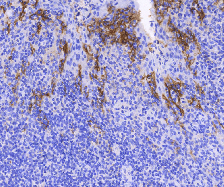 How to Interpret PD-L1 Positive Results in Cancer Diagnosis