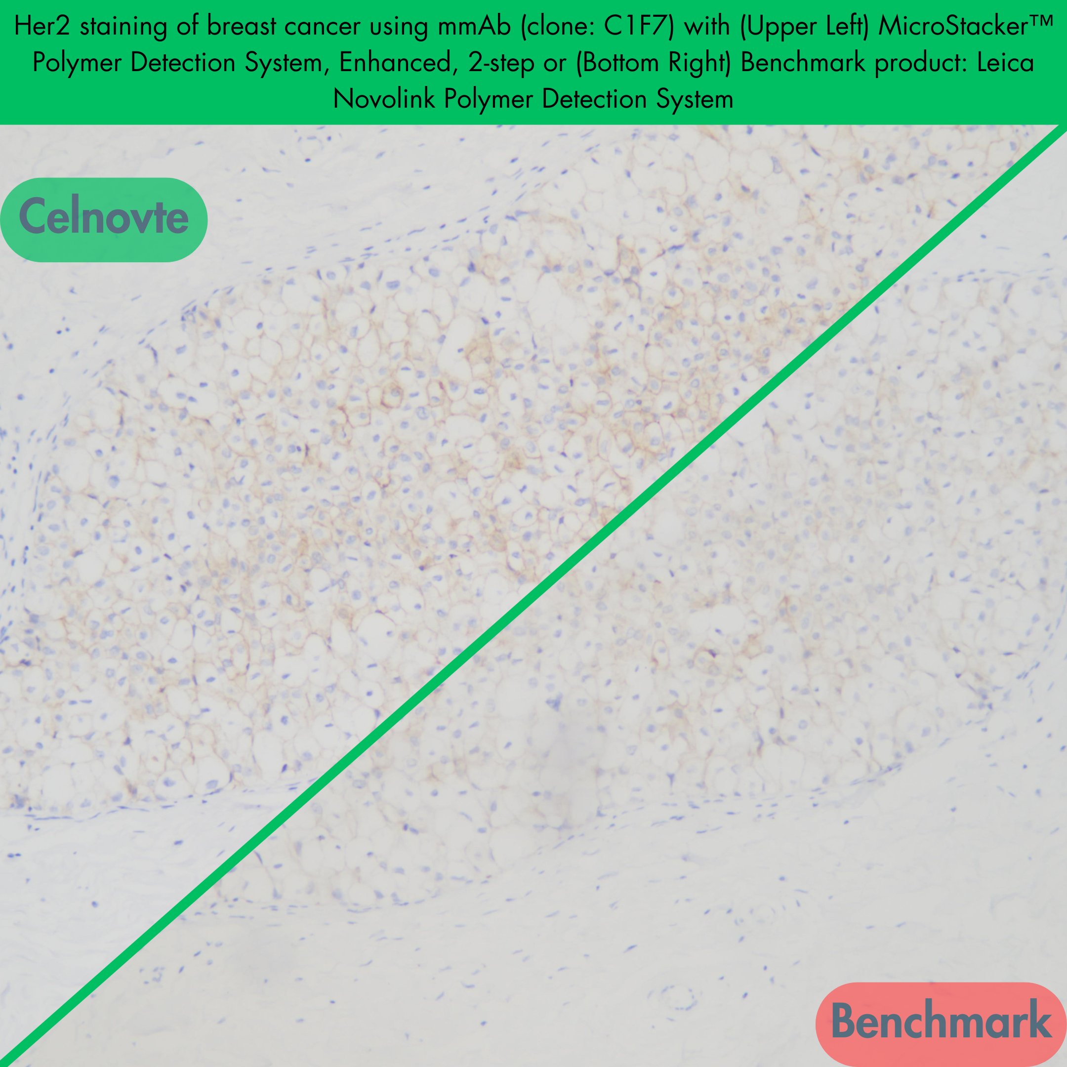 Her2 staining of breast cancer using mmAb (clone: C1F7) with (Upper Left) MicroStacker™ Polymer Detection System, Enhanced, 2-step or (Bottom Right) Benchmark product: Leica Novolink Polymer Detection System