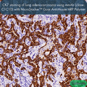 CK7 staining of lung adenocarcinoma using mmAb (clone: C1C10) with MicroStacker™ Goat Anti-Mouse HRP Polymer