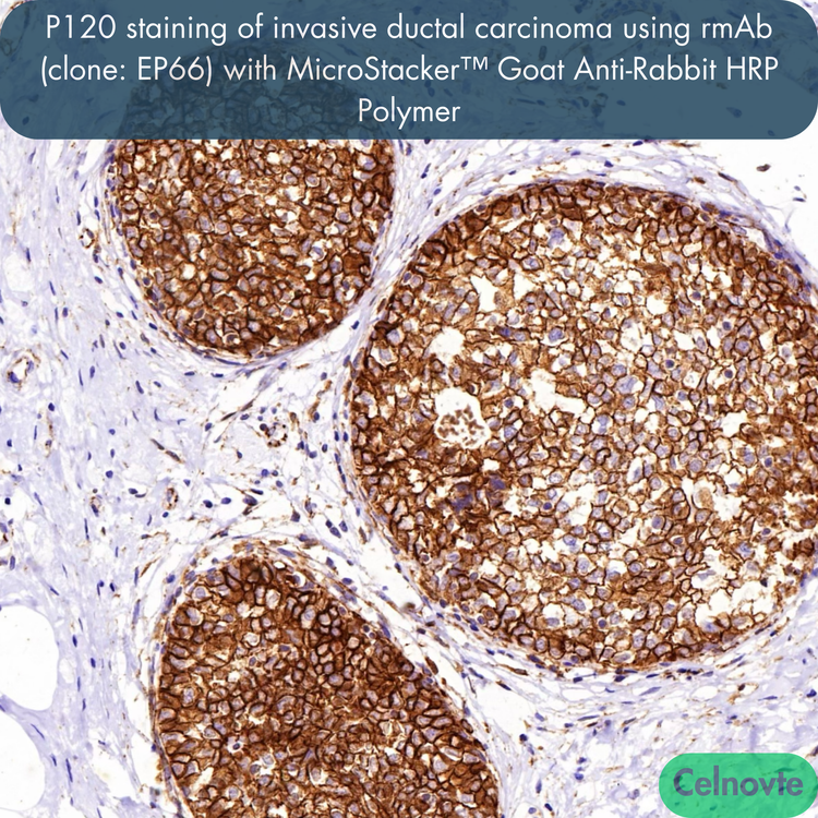 P120 staining of invasive ductal carcinoma using rmAb (clone: EP66) with MicroStacker™ Goat Anti-Rabbit HRP Polymer