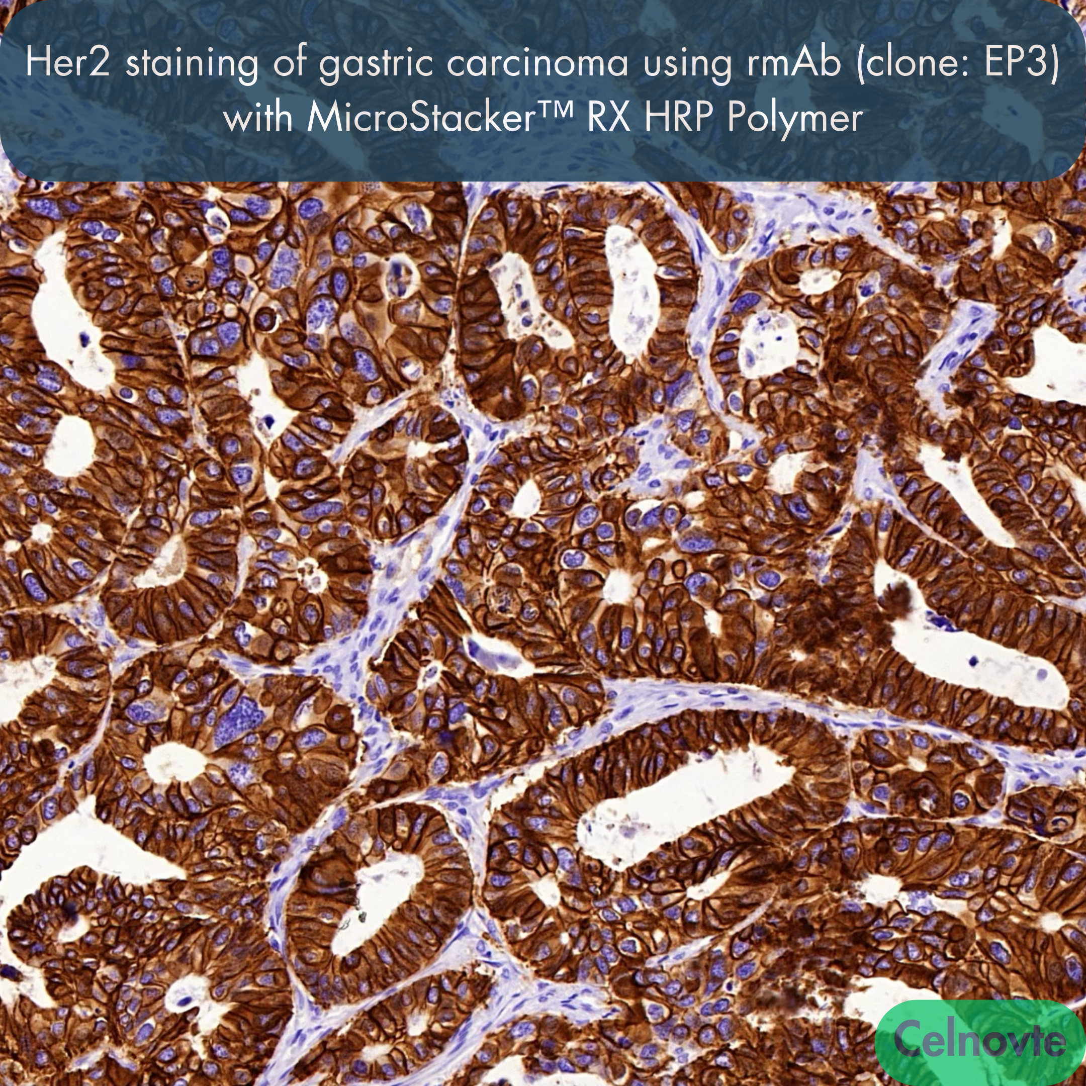 Her2 staining of gastric carcinoma using rmAb (clone: EP3) with MicroStacker™ RX HRP Polymer