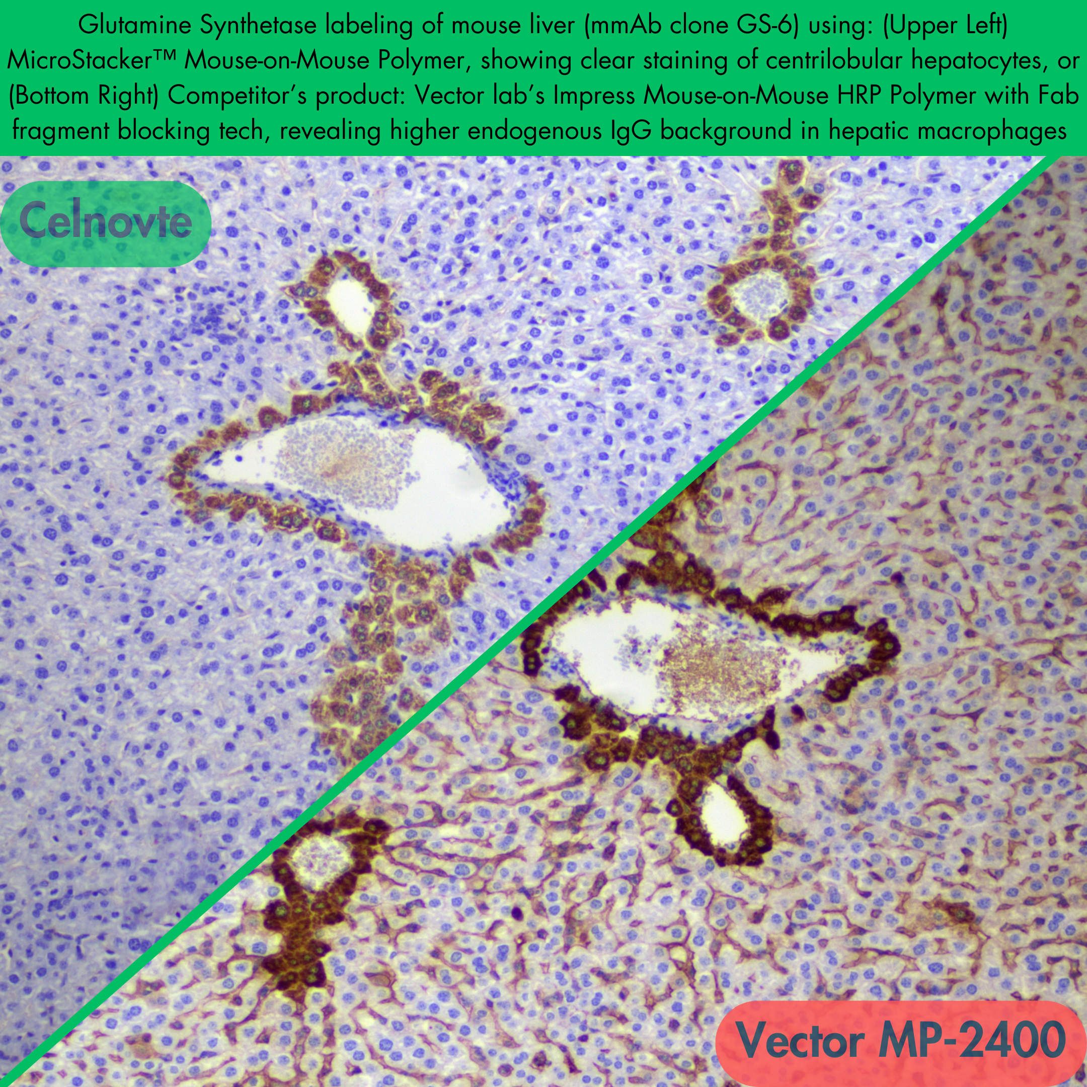 Glutamine Synthetase labeling of mouse liver (mmAb clone GS-6) using: (Upper Left) MicroStacker™ Mouse-on-Mouse Polymer, showing clear staining of centrilobular hepatocytes, or (Bottom Right) Competitor’s product: Vector lab’s Impress Mouse-on-Mouse HRP Polymer with Fab fragment blocking tech, revealing higher endogenous IgG background in hepatic macrophages.