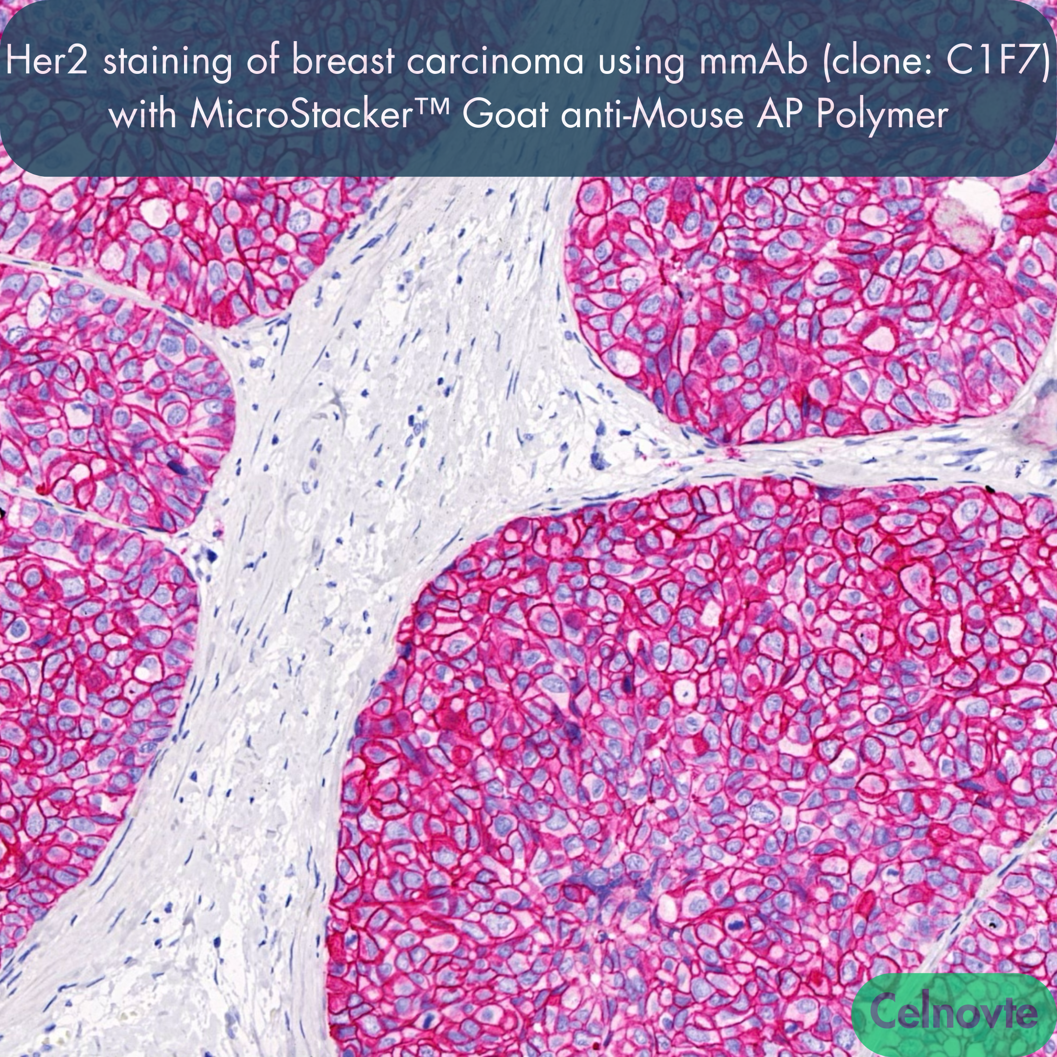 Her2 staining of breast carcinoma using mmAb (clone: C1F7) with MicroStacker™ Goat anti-Mouse AP Polymer