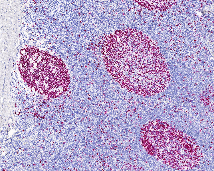 Ki-67 staining of tonsil using rmAb (clone: SP6) with MicroStackerTM Goat anti-Rabbit AP Polymer