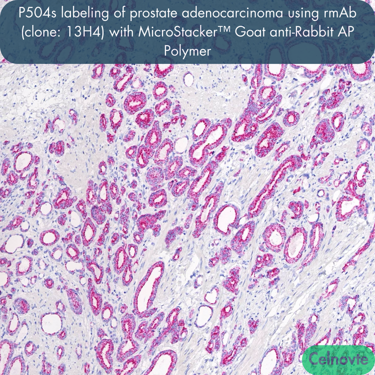 P504s labeling of prostate adenocarcinoma using rmAb (clone: 13H4) with MicroStacker™ Goat anti-Rabbit AP Polymer